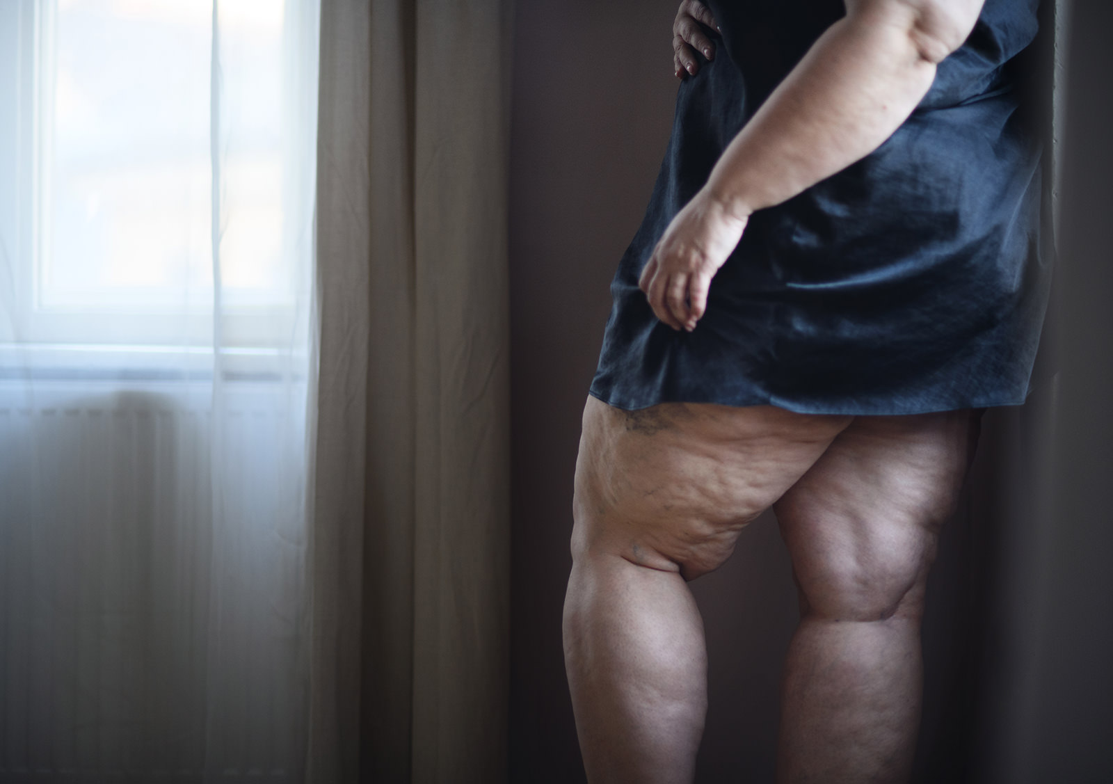 https://drdavidboudana.com/wp-content/uploads/2023/08/fat-woman-with-cellulite-on-her-legs-cut-out.jpg