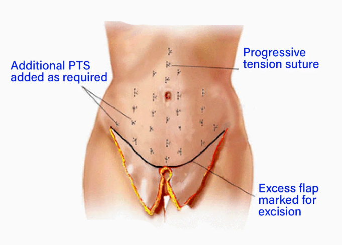 Medical illustration of progressive tension sutures (quilting stitches) placed across the abdomen to eliminate dead space.