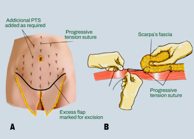 Detailed diagram showing how progressive tension sutures are applied to Scarpa’s fascia and excess skin flap
